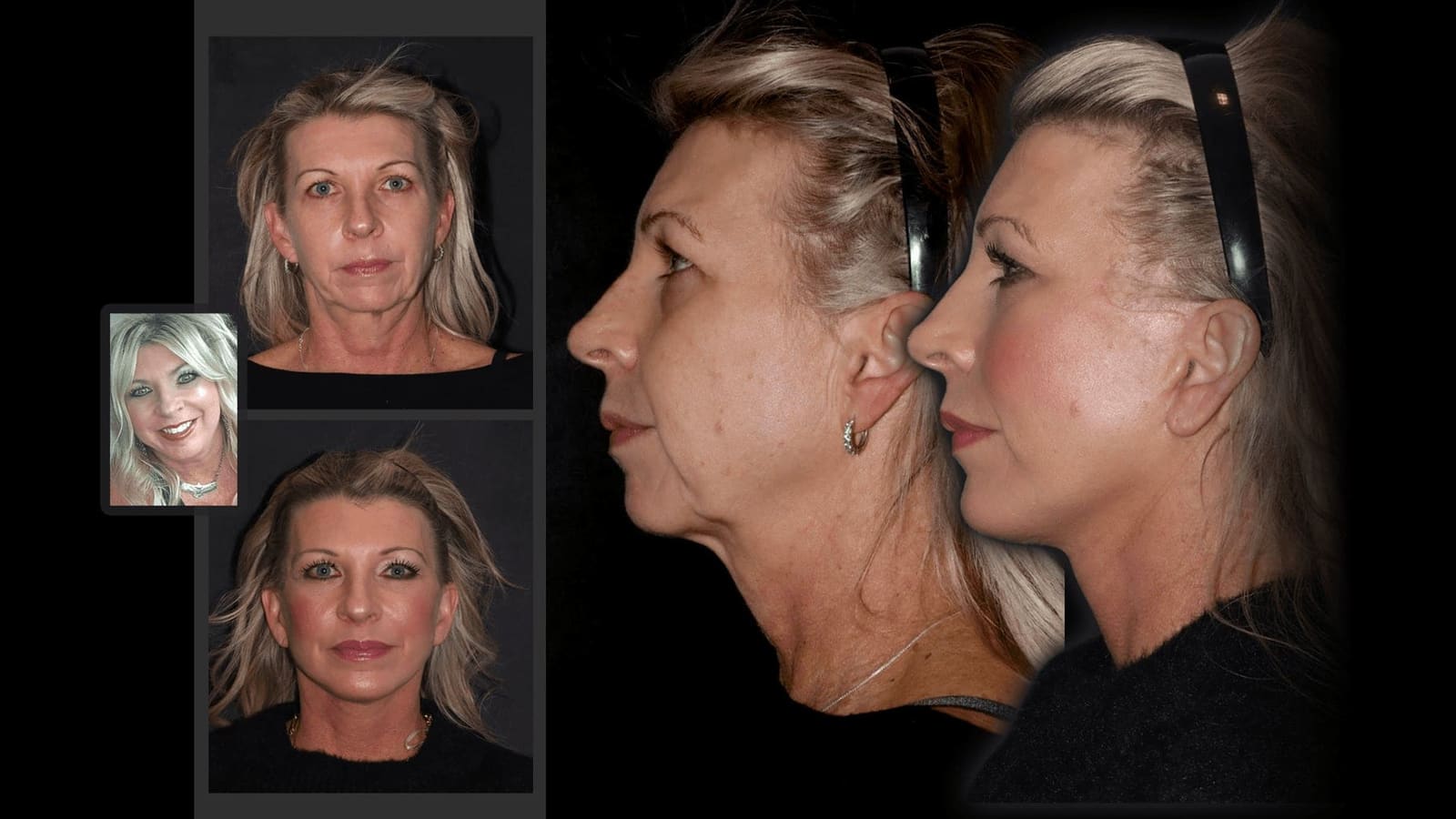 Case 0301 — comprehensive before and after montage, front and profile, twelve-month follow-up