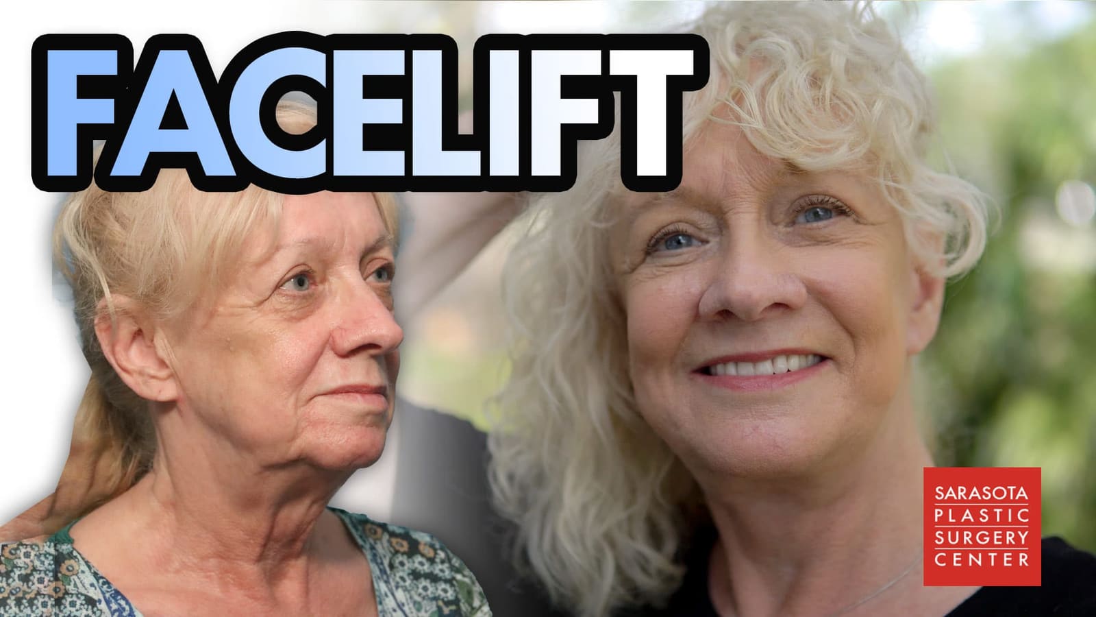 Cheryl's facelift — Dr. Engel — Sarasota Plastic Surgery Center