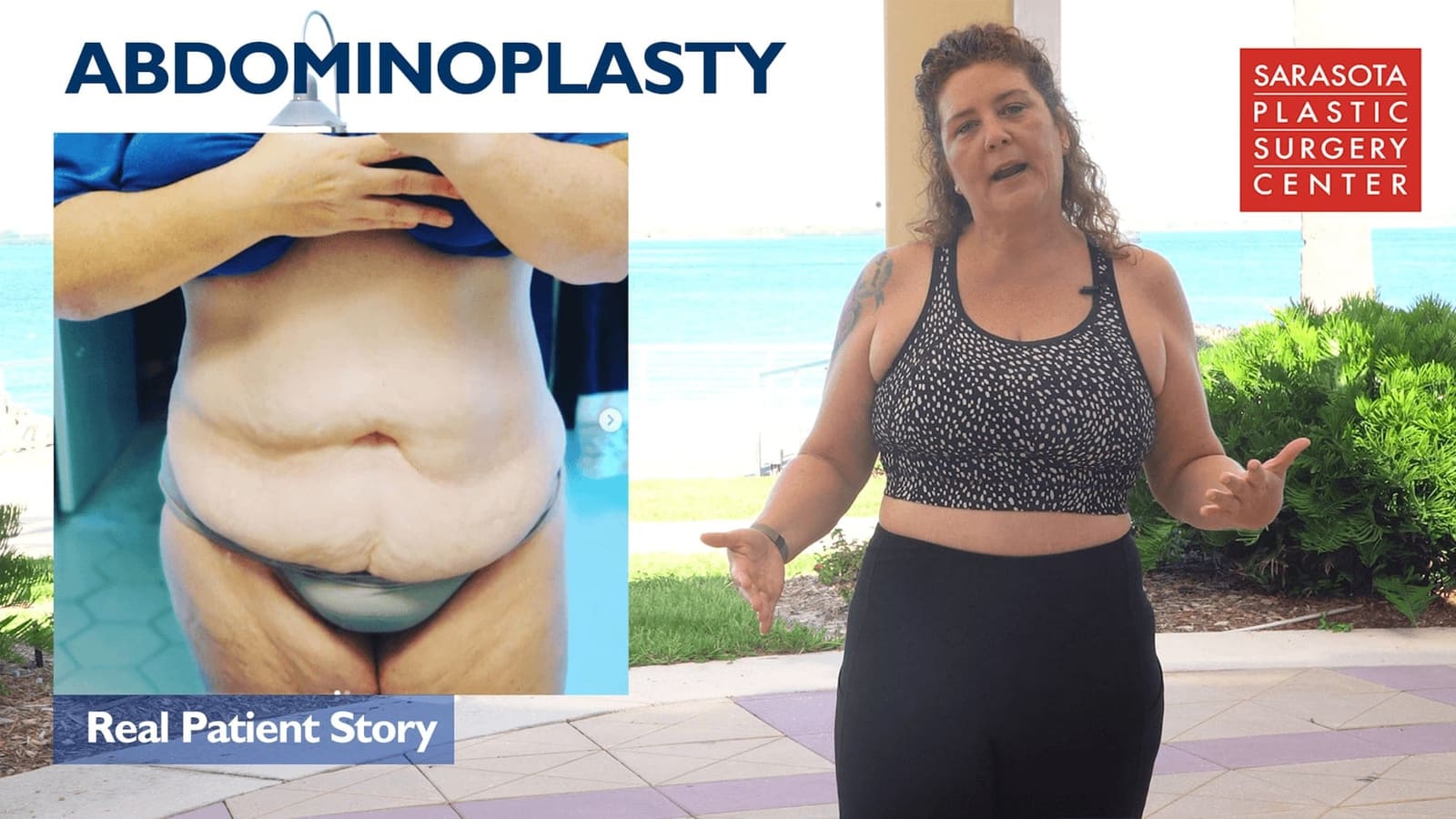 Shelby's abdominoplasty after 140 lbs weight loss — Dr. Derby — Sarasota Plastic Surgery Center